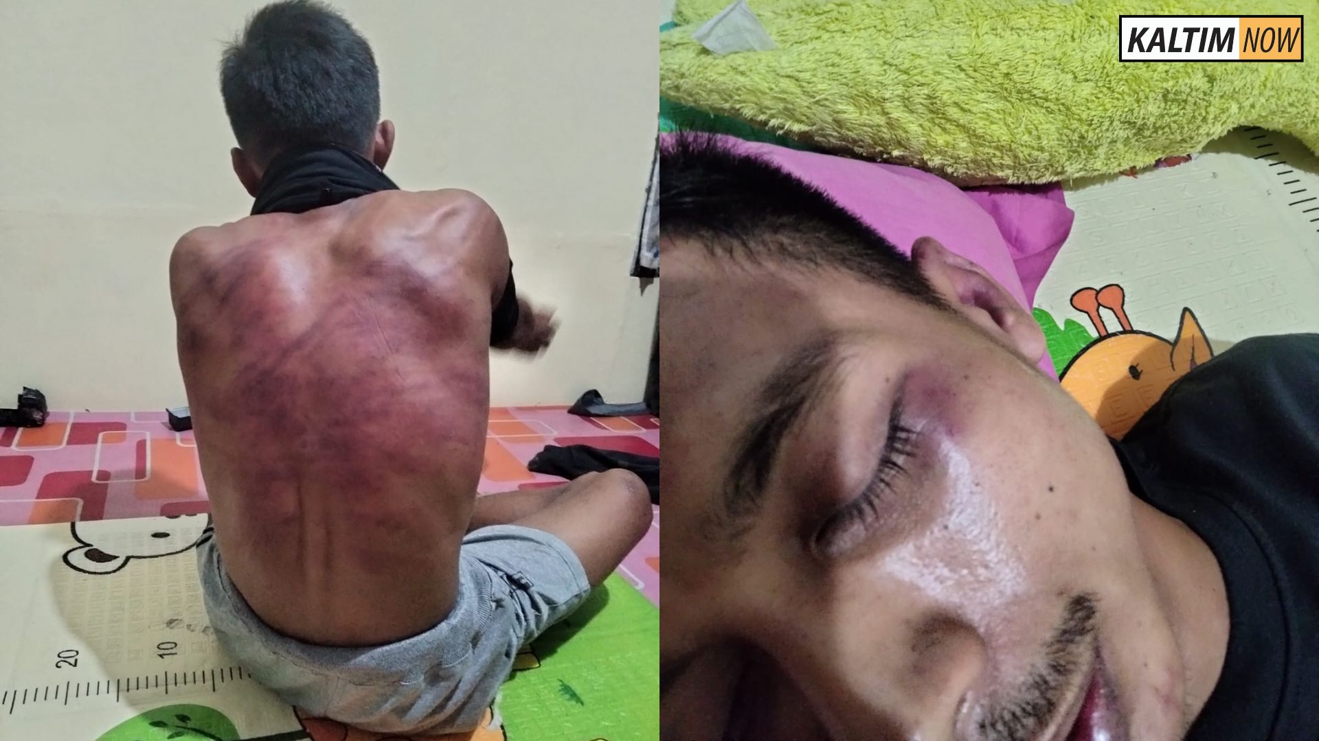 Foto: Seorang pengepul pisang bernama Puji Friayadi menjadi korban dugaan kekerasan yang dilakukan aparat Brimob Kukar. Sumber: Istimewa.